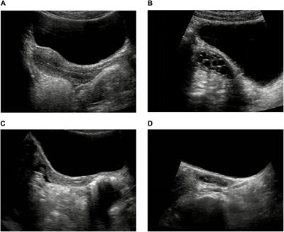 Pelvic Ultrasound in Diagnosing and Evaluating the Efficacy of Gonadotropin-Releasing Hormone Agonist Therapy in Girls With Idiopathic Central Precocious Puberty